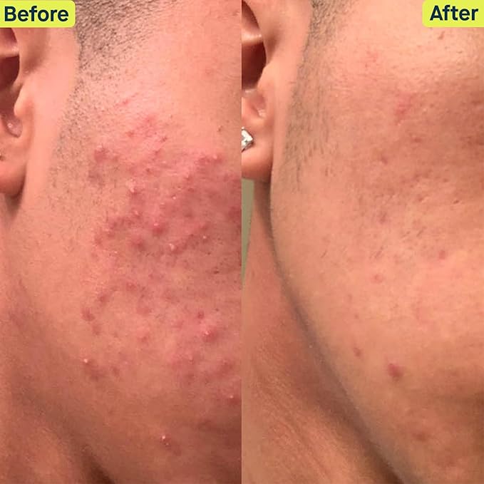 SLMD Skincare by Dr. Pimple Popper - 30-Day Acne System - 4-pc Kit - 3 Steps, 2x per Day Full Routine to Treat and Prevent All Stages of Acne