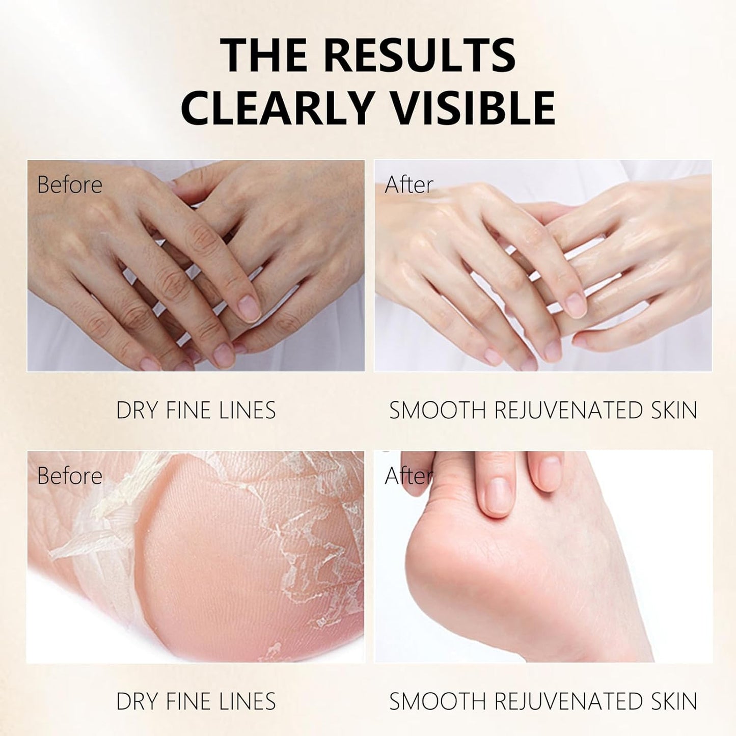 Hydrating Hand Foot Masks Set for Women Men,5 Pack Glove Mask for Dry Hand & 5 Pack Socks Mask for Dry Cracked Feet(Milk)