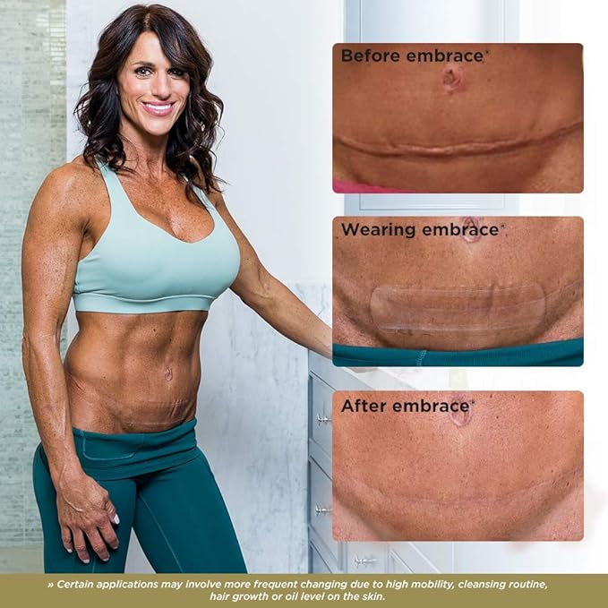 Embrace Scar Treatment, Silicone Sheets for New Scars with Active Scar Defense, Extra Large 6.3 Inch Sheets, 60 Day Supply (Recommended Treatment)