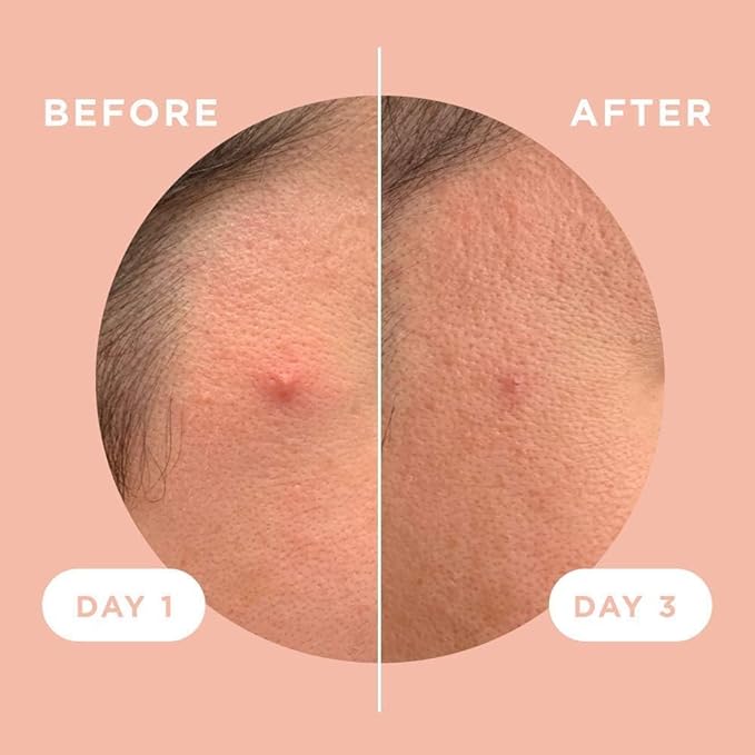 ZitSticka Killa Pimple Patches for Face - World's Most Potent Pimple Patch with Fast-Acting Microdarts - Starts Working within 6 Hours for Deep, Early-Stage Zits - Regular 12 Count with Cleana Swab