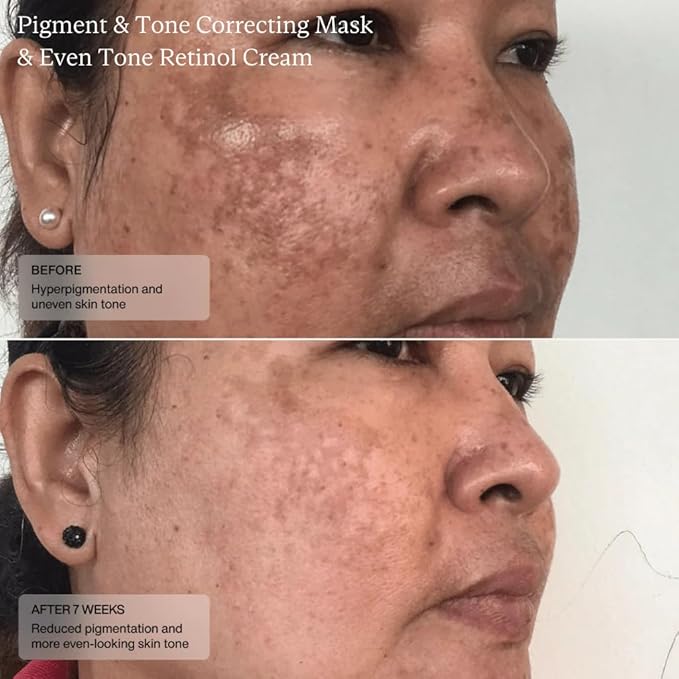 Senté Cysteamine HSA Pigment and Tone Corrector- Hyperpigmentation Treatment For Reducing The Appearance of Dark Spots And Improving Skin Tone - 1.7 Fl Oz