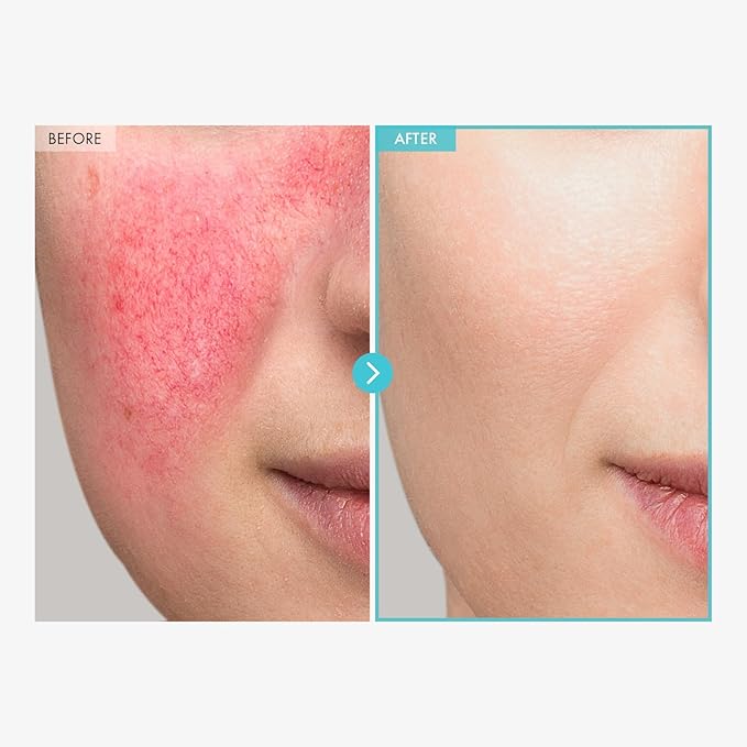 SOS Repair CICA Clinic Zinc Cream, 100,000ppm Zinc Oxide, Heal, Soothe Acne, Redness, Rosacea Treatment, Skin Barrier Repair, Moisture, Non-Comedogenic, Korean Skin care, 50g, 1.76 oz.