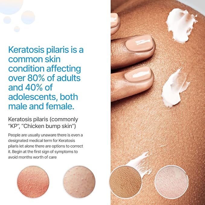 KP Essentials - Keratosis Pilaris Body Scrub and Exfoliator Cream Set - 10oz Exfoliating Set