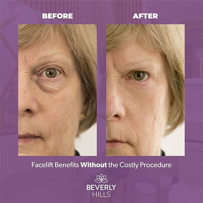 Beverly Hills V-Lift Instant Eye Lift and Eye Tuck Bee Venom Serum for Puffy Eyes, Dark Circles, Wrinkles, and Under Eye Bags Treatment for Women and Men | 30mL (120 Day Supply)