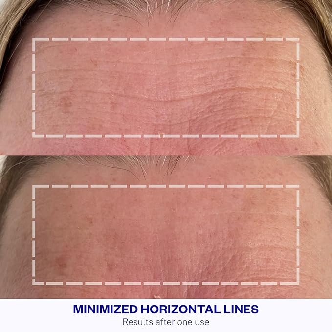 Wrinkles Schminkles Forehead Wrinkle Patches, 1-Pack, Reusable Hypoallergenic Silicone Smoothing Pads for Reducing Frown Lines & Face Lift Overnight