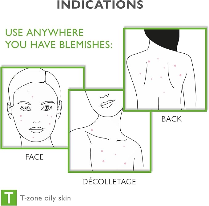 Face & Body Breakout Solution - 3% Mandelic Acid Helps Clarify Blemish & Acne Prone Skin, Face, Back & Chest Pimples Exfoliating & Clearing Treatment, SEBO-ALMOND-CLARIS, 6.42 fl oz