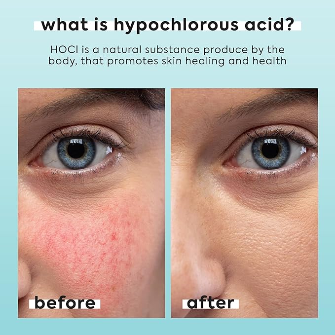 Hypochlorous Acid Spray for Face & Body - Helps Reduce Redness and Breakouts - Travel Size Hypochlorous Spray, Multi-Purpose Topical Facial Skin Repair, pH-Balancing Toner - TSA, Livaclean