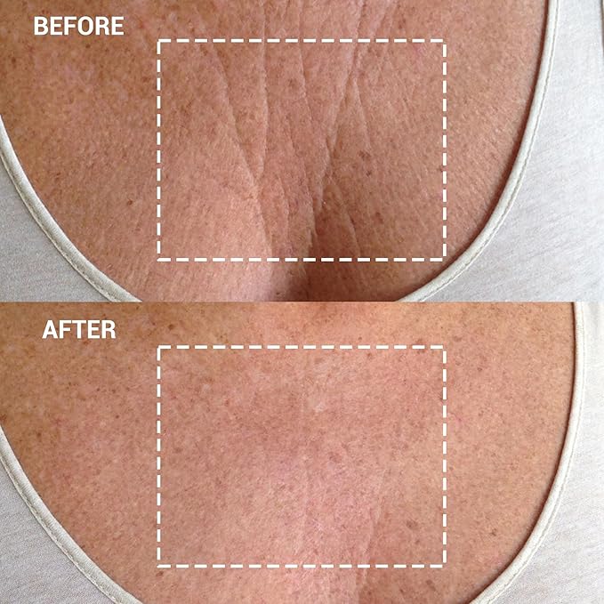 Wrinkles Schminkles Chest Wrinkle Patch & Cleanser Starter Pack - Set of Reusable Chest Silicone Wrinkle Patch + Patch Cleanser (2 oz) Maximise Uses - Smooth & Prevent Chest & Décolletage Wrinkles